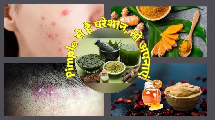 Pimple से हैं परेशान, तो अपनाएं